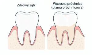 Porównanie zdrowego zęba i zęba z wczesną próchnicą. Szybkie leczenie próchnicy jest kluczowe.