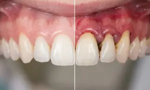 Zdrowe dziąsła vs. zapalenie przyzębia. Dowiedz się, czym jest periodontologia i jak dbać o zdrowie jamy ustnej.