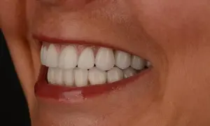 Piękne, białe zęby po zabiegu. Czy wybielanie zębów boli? Nie, jeśli wykonuje je profesjonalista.