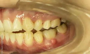 Antybiotyk na ząb z ropą: kiedy i jaki lek? Wizyta u dentysty.
