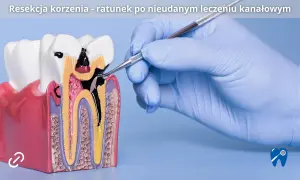 Model zęba z widocznym uszkodzeniem korzenia, nad którym pracuje stomatolog. To przykład sytuacji, gdzie resekcja zęba jest ratunkiem po nieudanym leczeniu kanałowym.