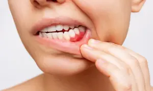Opuchnięte dziąsła: Przyczyny, domowe sposoby i kiedy iść do dentysty