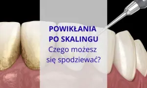 Jak bezpiecznie usunąć ząb? Unikaj bólu i powikłań