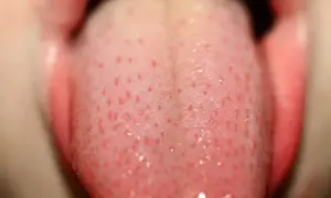 Objawy HPV w jamie ustnej i gardle: objawy, ryzyko, leczenie