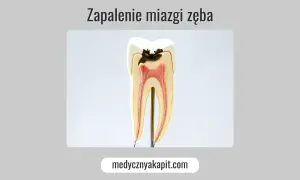 Zakażenie od zęba: Objawy ogólnoustrojowe i groźne powikłania