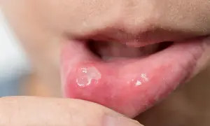 Afta u dentysty? Kiedy wizyta jest możliwa, a kiedy przełożyć?
