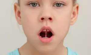 Dziecko z otwartymi ustami, pokazujące podcięcie wędzidełka. Czy podcięcie wędzidełka boli? To pytanie nurtuje wielu rodziców.
