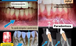 Zanikanie dziąseł i kości to paradontoza. Zobacz, jak odbudować dziąsła i kość, by uratować zęby.