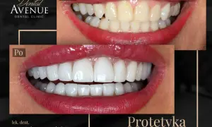 Przed i po: metamorfoza uśmiechu z licówkami porcelanowymi. Dowiedz się, licówki porcelanowe ile wytrzymują, by cieszyć się pięknym uśmiechem latami.