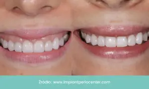 Uśmiech przed i po: zredukowany gummy smile, piękne, białe zęby.