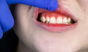 Torbiel na dziąśle: objawy, przyczyny i kiedy iść do dentysty