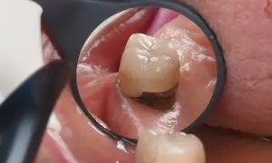 Widok zęba w lustrze dentystycznym. Widoczne dziąsło w dziurze zęba, z ciemnym wypełnieniem.