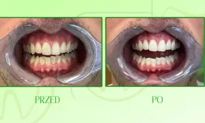 Wybielanie zębów u dentysty: Czy warto? Cena, metody, efekty