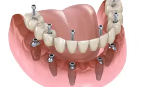 Koszt wstawienia 6 zęba: Ile zapłacisz za implant i most?