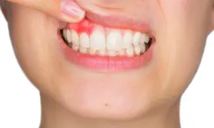 Krwawiące dziąsła: Szybkie sposoby, przyczyny i kiedy iść do dentysty