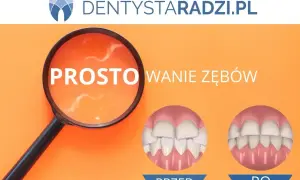 Proste licówki na krzywe zęby. Zobacz metamorfozę uśmiechu przed i po zabiegu.