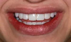 Uśmiech z idealnie białymi zębami, uzupełnionymi dzięki flow injection a bonding.