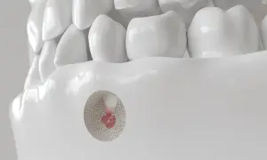 Model zębów z widocznym przekrojem ukazującym resekcję wierzchołka korzenia.