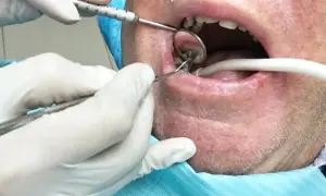 Dentysta usuwa korzeń zęba z ropą. Widoczne narzędzia stomatologiczne, lusterko i ślinociąg.