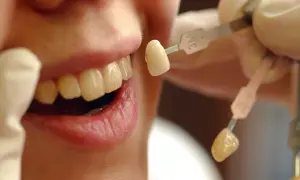 Dopasowanie koloru licówek do naturalnych zębów. Zobacz, co to licówki i jak odmienią Twój uśmiech.