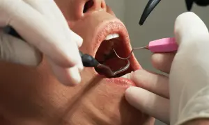 Dentysta usuwa szwy z dziąsła. Czy ściąganie szwów z dziąsła boli? Zależy od indywidualnego progu bólu.