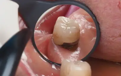 Widok zęba w lustrze dentystycznym. Widoczne dziąsło w dziurze zęba, z ciemnym wypełnieniem.