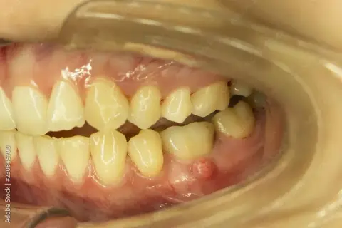 Antybiotyk na ząb z ropą: kiedy i jaki lek? Wizyta u dentysty.