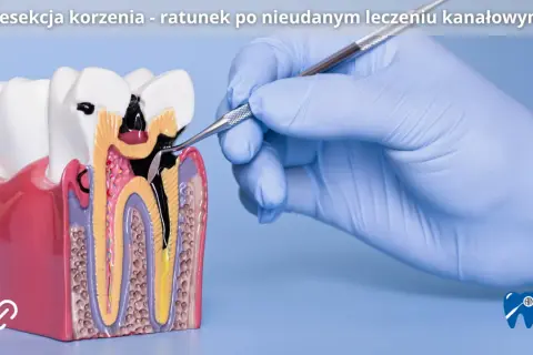 Model zęba z widocznym uszkodzeniem korzenia, nad którym pracuje stomatolog. To przykład sytuacji, gdzie resekcja zęba jest ratunkiem po nieudanym leczeniu kanałowym.