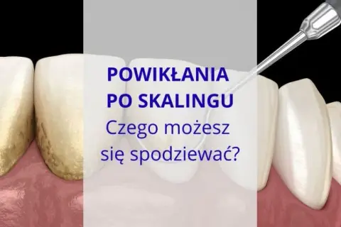 Jak bezpiecznie usunąć ząb? Unikaj bólu i powikłań