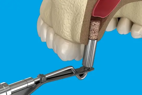 Zabieg augmentacji kości: implant kostny umieszczany w wyrostku zębodołowym po wyrwaniu zęba.