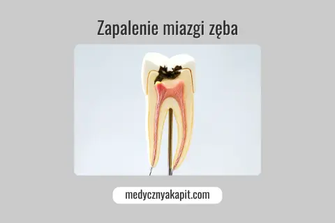 Zakażenie od zęba: Objawy ogólnoustrojowe i groźne powikłania