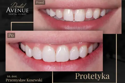 Przed i po: metamorfoza uśmiechu dzięki licówkom. Różne rodzaje licówek pozwalają na idealne dopasowanie do potrzeb pacjenta.