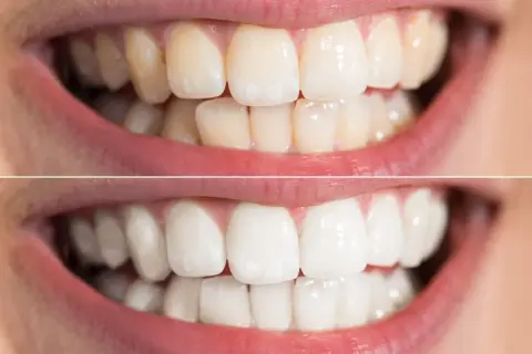 Przed i po wybielaniu zębów. Górny rząd pokazuje żółtawe zęby, dolny – olśniewająco białe. Niesamowite efekty wybielania zębów!