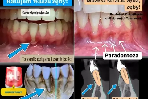 Zanikanie dziąseł i kości to paradontoza. Zobacz, jak odbudować dziąsła i kość, by uratować zęby.