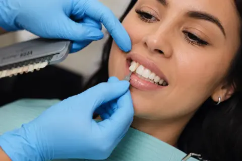 Dobór idealnego odcienia pasty do licówek kompozytowych. Dentysta porównuje kolor zębów pacjentki z wzornikiem.
