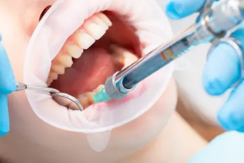 Znieczulenie u dentysty w ciąży: Czy jest bezpieczne? Poradnik