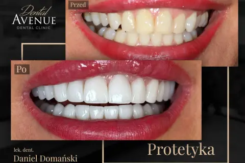 Przed i po: metamorfoza uśmiechu z licówkami porcelanowymi. Dowiedz się, licówki porcelanowe ile wytrzymują, by cieszyć się pięknym uśmiechem latami.