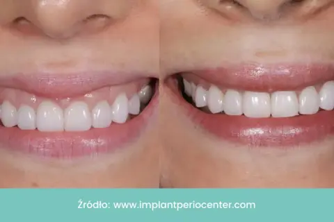 Uśmiech przed i po: zredukowany gummy smile, piękne, białe zęby.