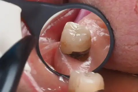 Widok zęba w lustrze dentystycznym. Widoczne dziąsło w dziurze zęba, z ciemnym wypełnieniem.