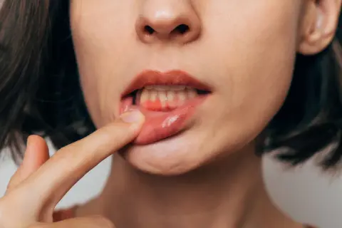 Jak usunąć jedzenie z dziąsła? Domowe sposoby i kiedy iść do dentysty