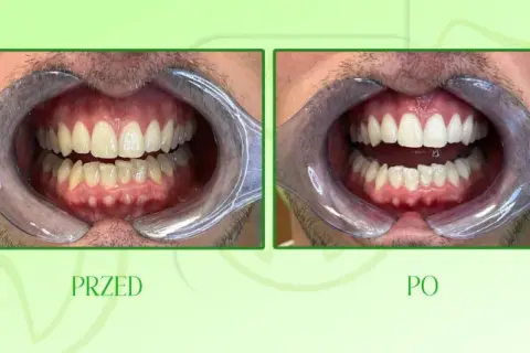 Wybielanie zębów u dentysty: Czy warto? Cena, metody, efekty