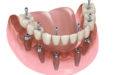 Koszt wstawienia 6 zęba: Ile zapłacisz za implant i most?