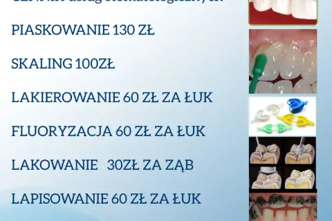 Ile kosztuje wyrwanie zęba w Polsce? Ceny i porównanie NFZ