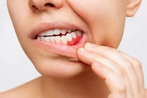 Ból dziąsła: Szybka ulga, przyczyny i kiedy iść do dentysty