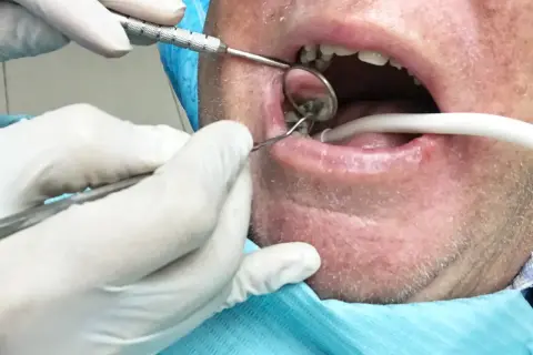 Dentysta usuwa korzeń zęba z ropą. Widoczne narzędzia stomatologiczne, lusterko i ślinociąg.