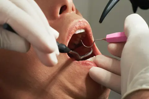 Dentysta usuwa szwy z dziąsła. Czy ściąganie szwów z dziąsła boli? Zależy od indywidualnego progu bólu.