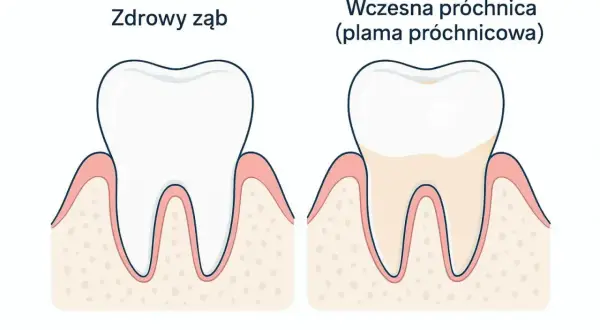 Porównanie zdrowego zęba i zęba z wczesną próchnicą. Szybkie leczenie próchnicy jest kluczowe.