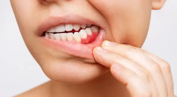Opuchnięte dziąsła: Przyczyny, domowe sposoby i kiedy iść do dentysty