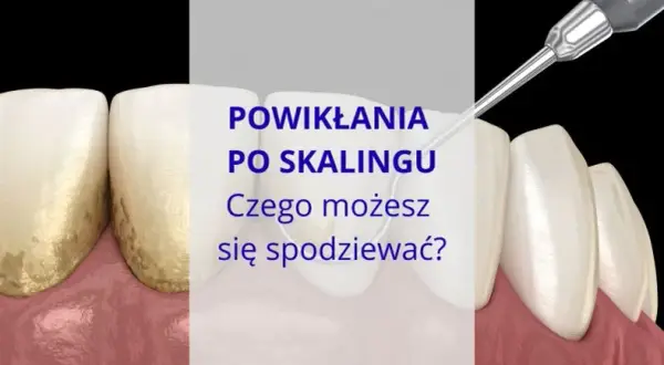 Jak bezpiecznie usunąć ząb? Unikaj bólu i powikłań