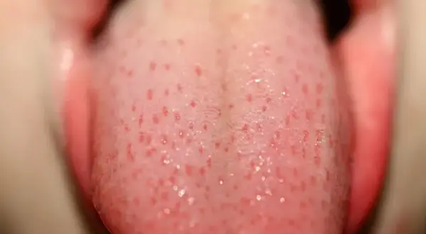 Objawy HPV w jamie ustnej i gardle: objawy, ryzyko, leczenie